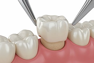Where your dental crown is placed could affect the cost