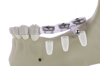 Illustration showing surgical guide for dental implant surgery